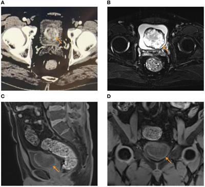 A rare huge bladder inflammatory myofibroblastic tumor treated by en bloc resection with diode laser: a case report and literature review